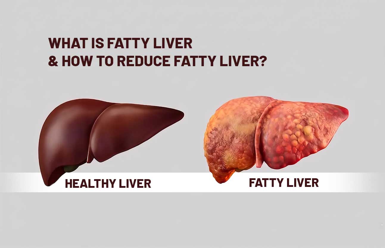 What Is Fatty Liver Disease and How Can You Reduce It Naturally?