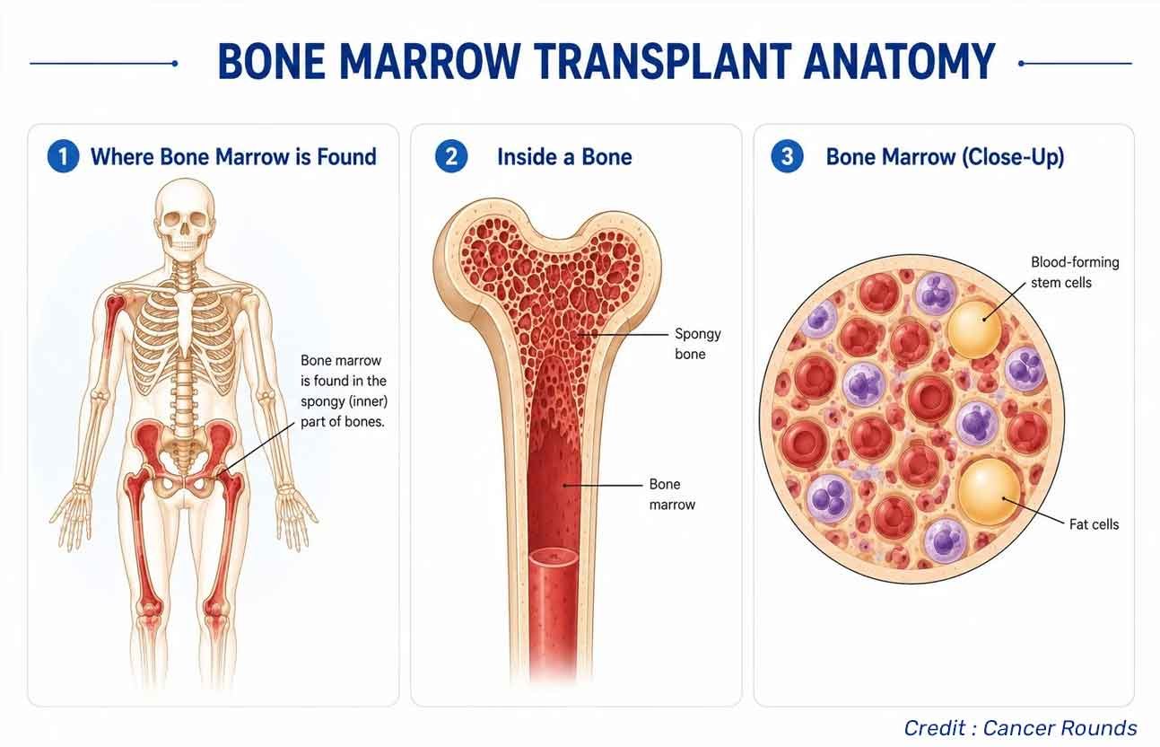 How Much Does a Bone Marrow Transplant Cost in Kerala, India?