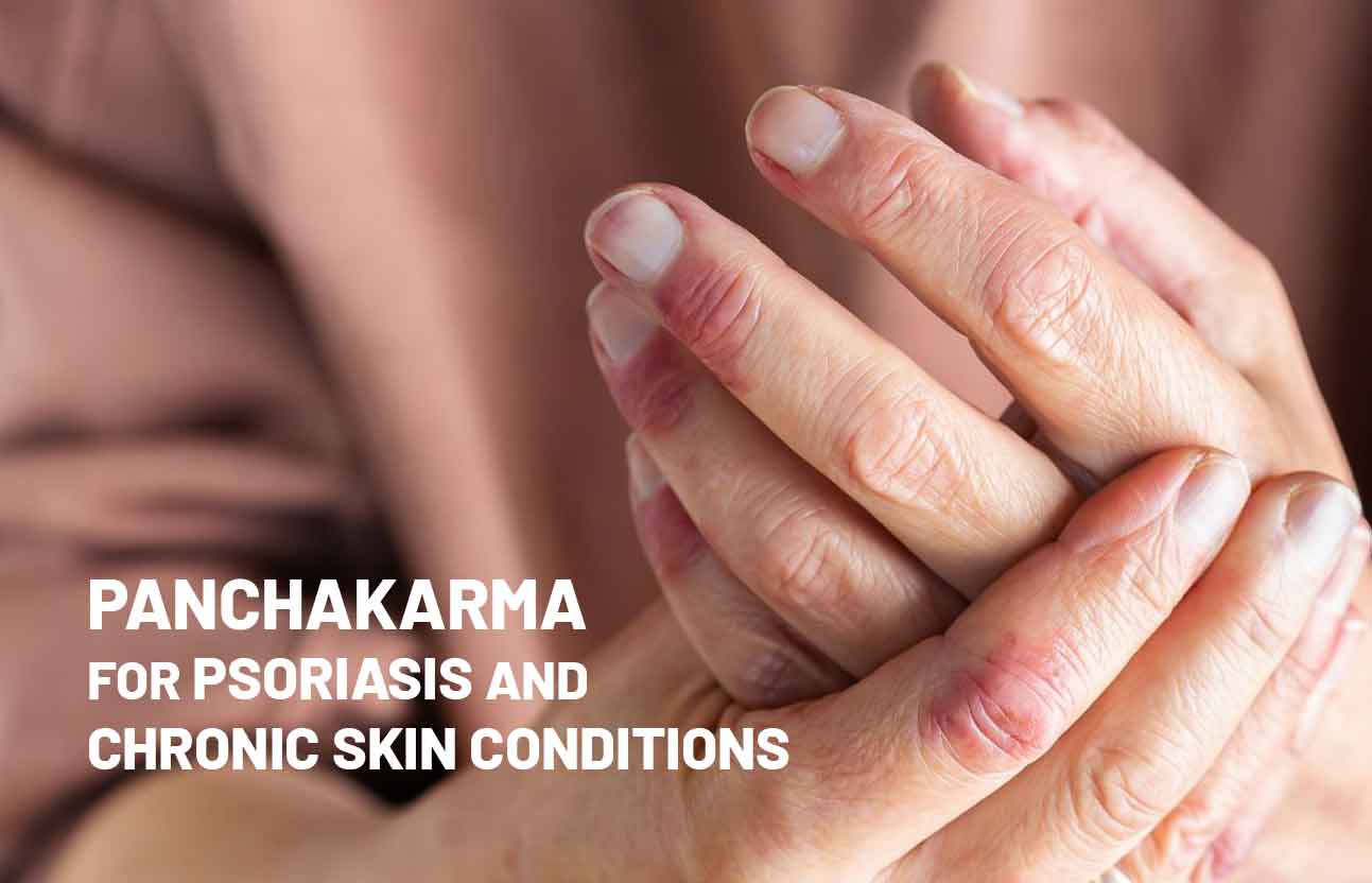 Panchakarma for Psoriasis and Chronic Skin Conditions: Can Ayurveda Help Restore Healthy Skin?