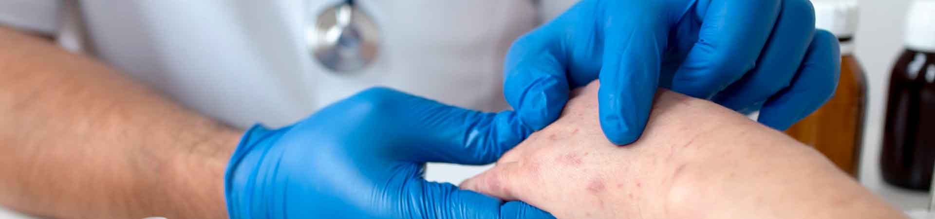 Psoriasis Treatment