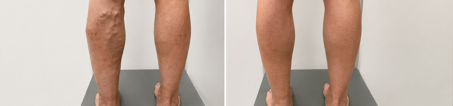 Alternative Treatment for Varicose Veins in India
