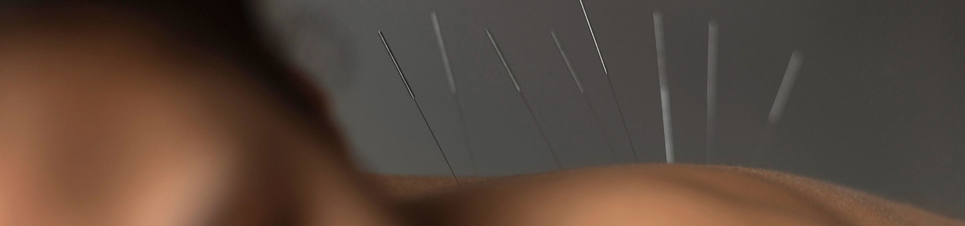 Acupuncture